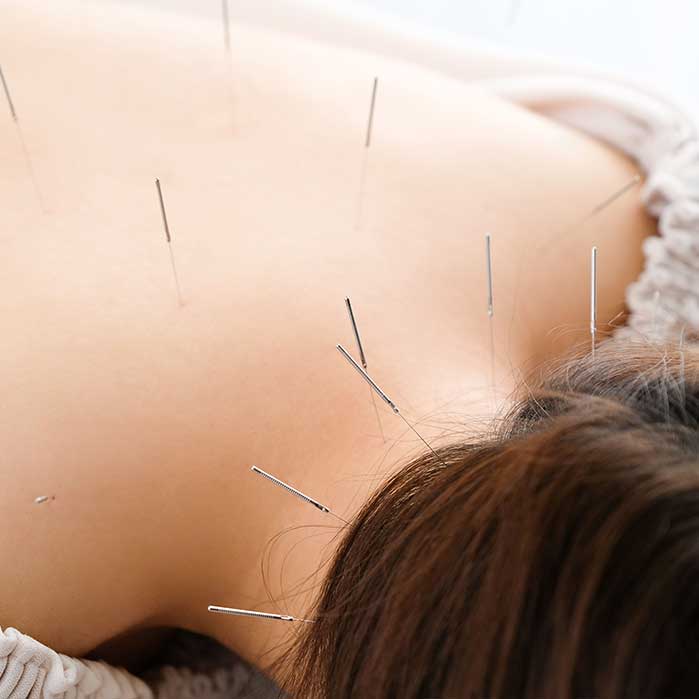 Acupuncture in Redmond